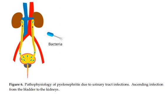 Figure 6. Pathophysiology of pyelonephritis due to urinary tract infections. Ascending infection from the bladder to the kidneys.