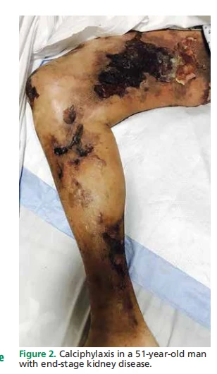 Figure 2. Calciphylaxis in a 51-year-old man  with end-stage kidney disease.
