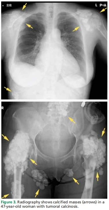 Figure 3. Radiography shows calcified masses (arrows) in a  47-year-old woman with tumoral calcinosis.